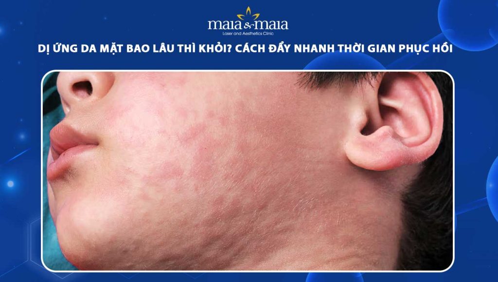 dị ứng da mặt bao lâu thì khỏi
