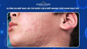 dị ứng da mặt bao lâu thì khỏi