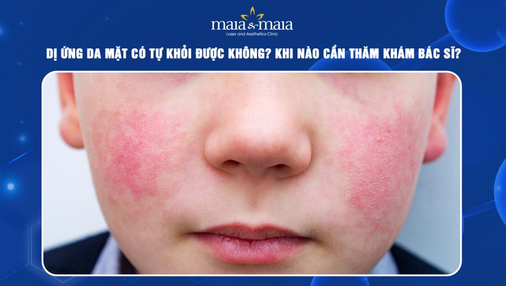 Dị ứng da mặt có tự khỏi được không
