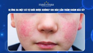 Dị ứng da mặt có tự khỏi được không