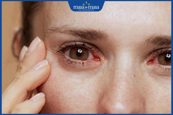 Thế nào là dị ứng thuốc nhỏ mắt? Cách xử lý và phòng ngừa 2 dị ứng đỏ mắt