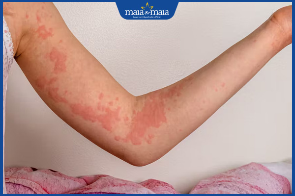 Dị ứng thời tiết có đáng lo ngại? Hướng điều trị, phòng ngừa 4 dị ứng gây mề đay