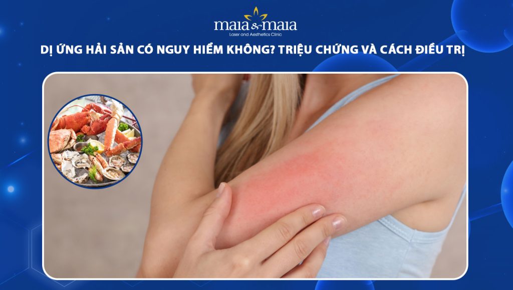 dị ứng hải sản