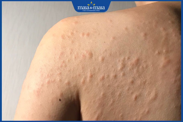 dị ứng hải sản nổi mẩn đỏ