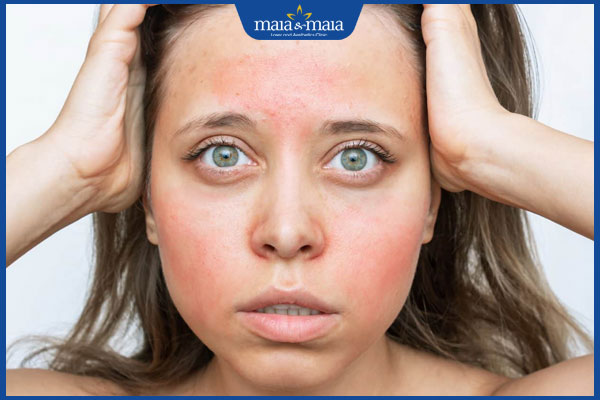 Danh sách các loại dị ứng thường gặp và biện pháp xử lý 5 dị ứng khi dùng mỹ phẩm