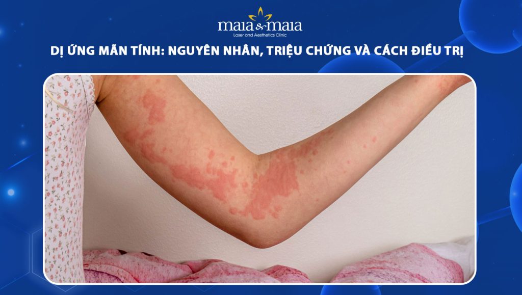 dị ứng mãn tính