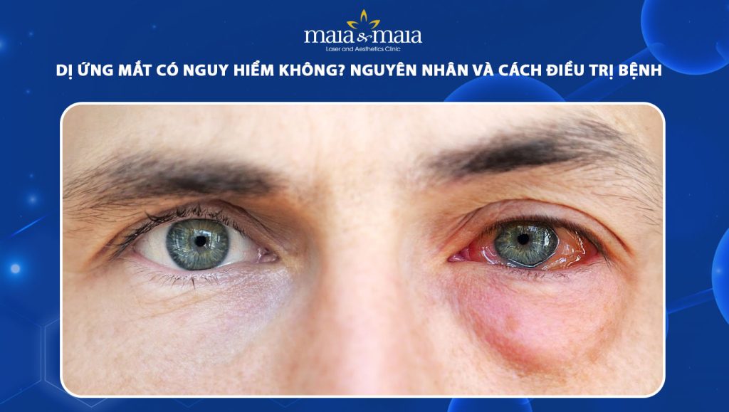 Dị ứng mắt có nguy hiểm không? Nguyên nhân và cách điều trị 1 dị ứng mắt