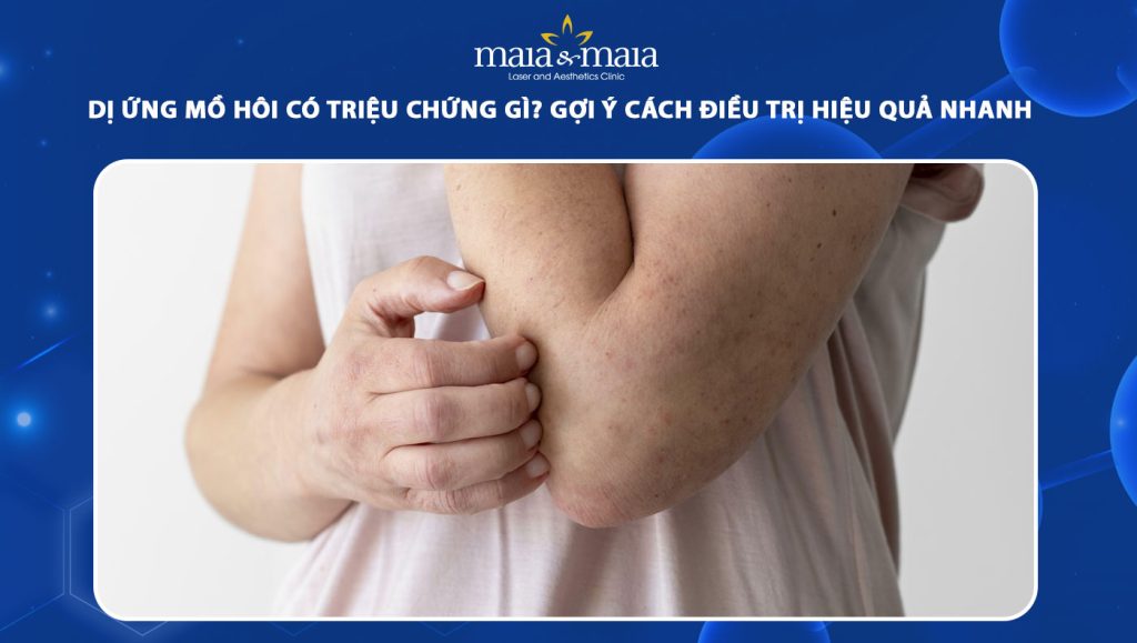 dị ứng mồ hôi