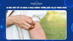 dị ứng thời tiết