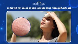 dị ứng thời tiết mùa hè