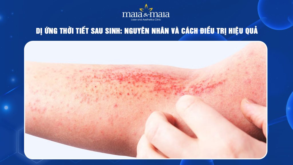 dị ứng thời tiết sau sinh