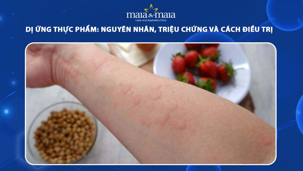Dị ứng thực phẩm: Nguyên nhân, triệu chứng và cách điều trị 1 dị ứng thực phẩm