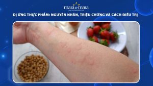 dị ứng thực phẩm