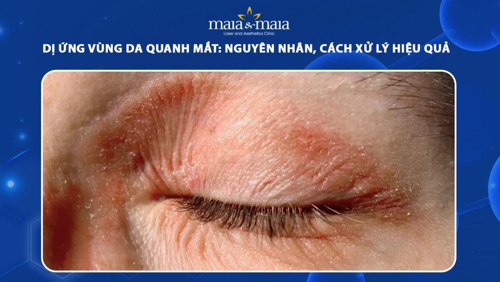 Dị ứng vùng da quanh mắt: Nguyên nhân, cách xử lý hiệu quả 1 dị ứng vùng da quanh mắt