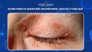 dị ứng vùng da quanh mắt
