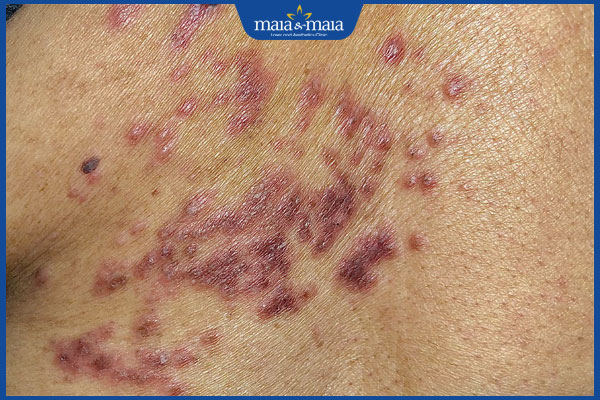 điều trị zona chậm trễ dễ gây sẹo