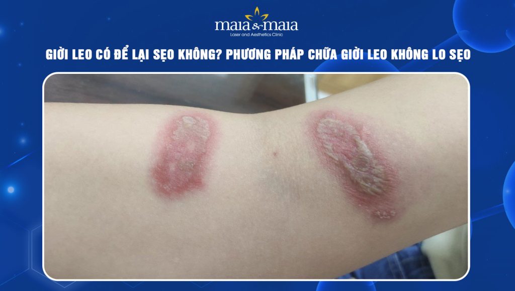 giời leo có để lại sẹo không