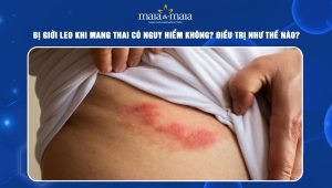 giời leo khi mang thai