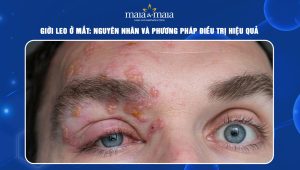 giời leo ở mắt