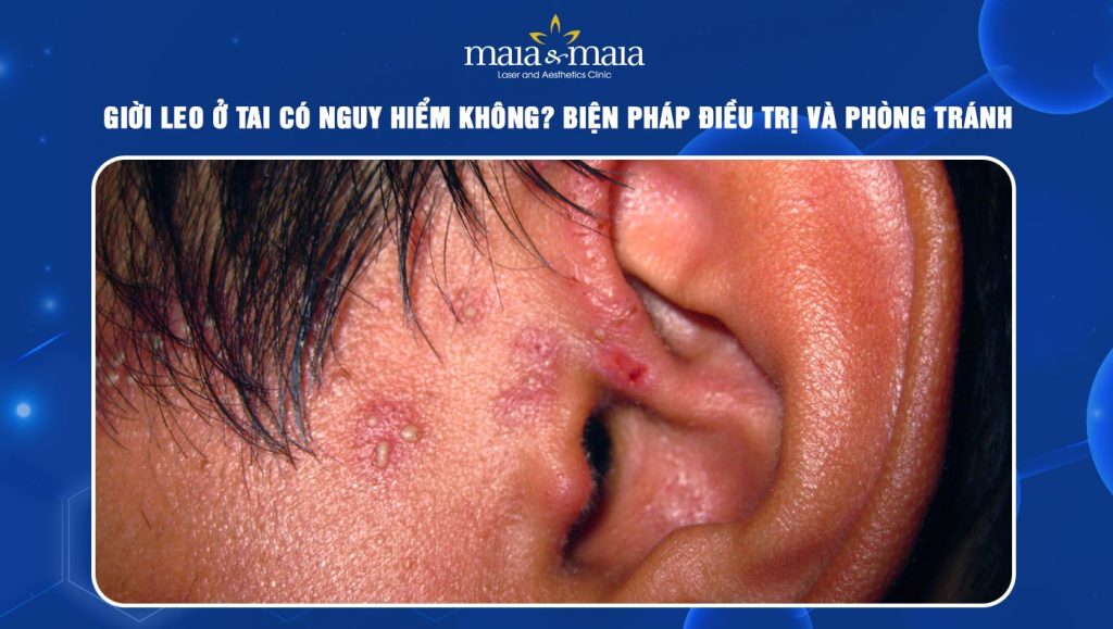 Giời leo ở tai