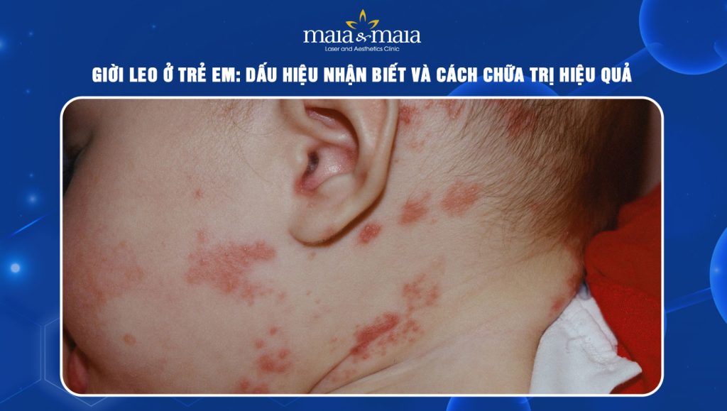 giời leo ở trẻ em