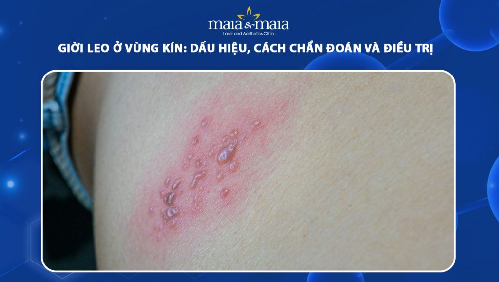 Giời leo ở vùng kín: Dấu hiệu, cách chẩn đoán và điều trị 1 giời leo ở vùng kín