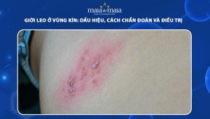 giời leo ở vùng kín