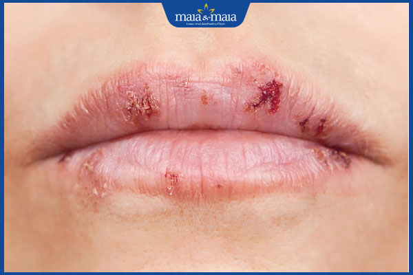 giời leo xung quanh miệng