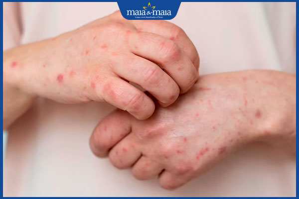 lây zona qua mụn nước