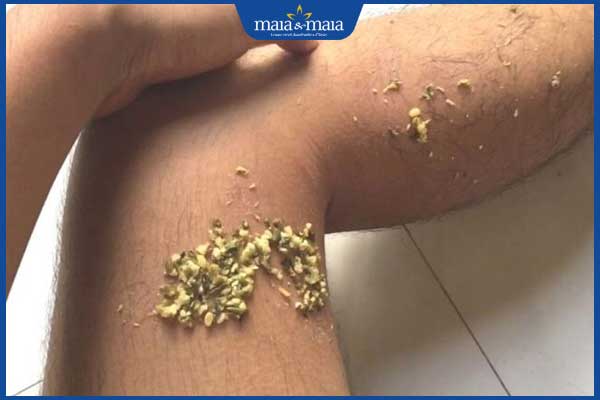 lưu ý khi trị giời leo bằng đậu xanh