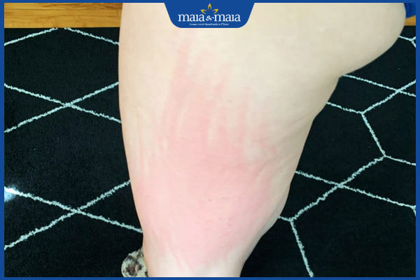 mẩn ngứa sau tiếp xúc tinh trùng