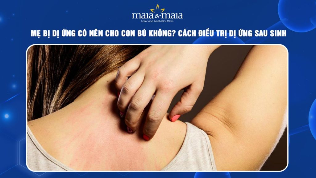 Mẹ bị dị ứng có nên cho con bú không