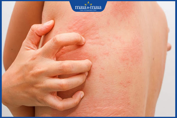 mề đay ngứa ngáy