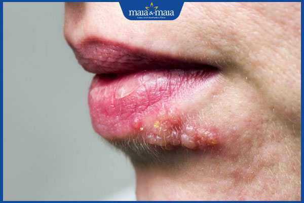 môi bị zona
