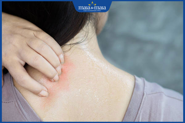 ngứa da dữ dội