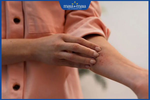 ngứa ngáy do dị ứng