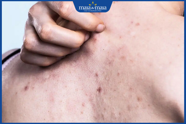 ngứa ở vùng da mụn