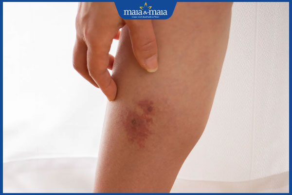 nguyên nhân gây zona ở chân