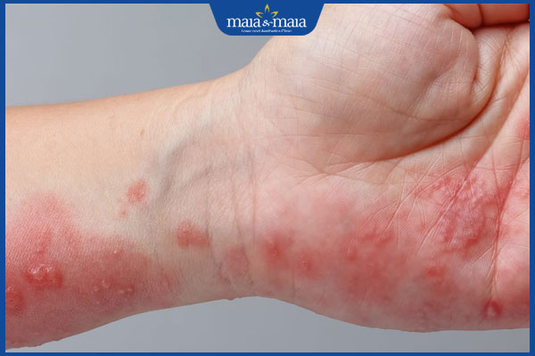 Bệnh zona ở tay có nguy hiểm không? Điều trị và phòng ngừa 2 nhận biết bệnh zona ở tay