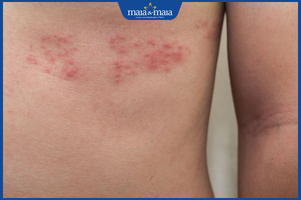 nhận biết bị zona ở trẻ