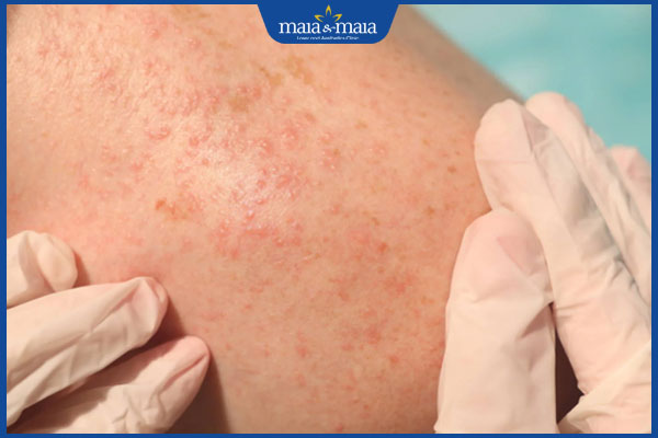 Dị ứng hải sản nguy hiểm không? Triệu chứng và cách điều trị 6 nổi mụn nước do dị ứng hải sản