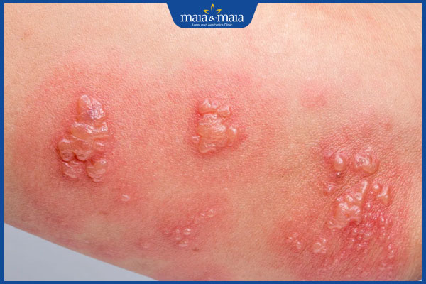 Zona thần kinh ở vùng kín có nguy hiểm không? Cách xử lý 3 nổi mụn nước ở vùng kín