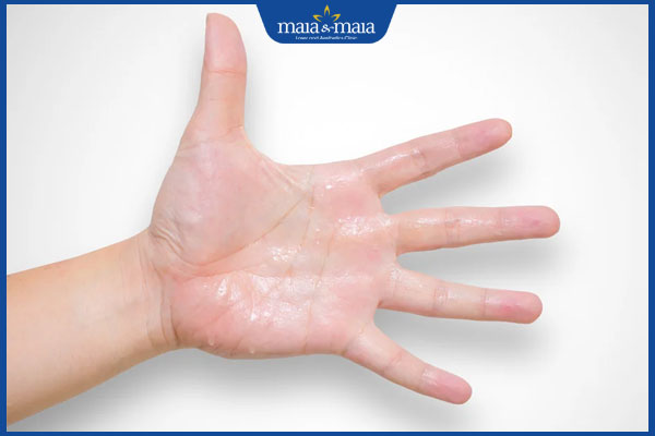 tăng tiết mồ hôi tay