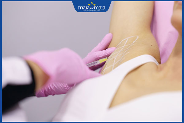 Công nghệ Maitrix Dry điều trị hôi nách, mồ hôi tay, chân 2 tiêm botox trị tăng tiết mồ hôi