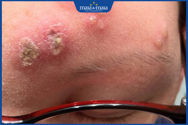 tình trạng bị zona thần kinh ở đầu