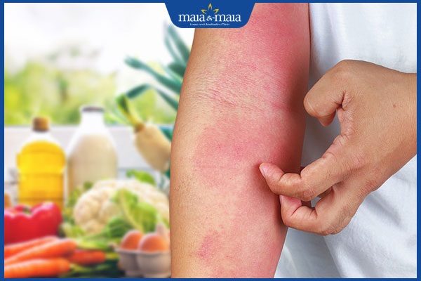 Dị ứng thực phẩm: Nguyên nhân, triệu chứng và cách điều trị 2 tình trạng dị ứng thực phẩm