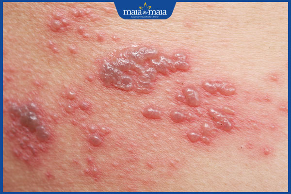 tình trạng giời leo