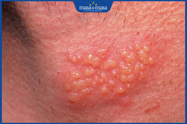 tình trạng nổi zona thần kinh ở vùng kín