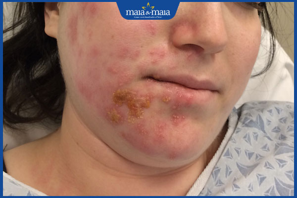 Zona hạch gối: Triệu chứng, nguyên nhân và cách điều trị 2 tình trạng zona hạch gối