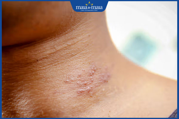 tình trạng zona ở cổ